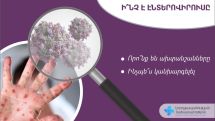Ինչ է էնտերովիրուսը և որոնք են ախտանշանները
