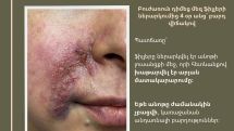 Շուրթերի սխալ ներարկման հետևանքով շտապ օգնություն պահանջող դեպքերը հաճախացել են. Ահազանգ