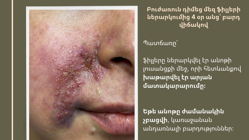 Շուրթերի սխալ ներարկման հետևանքով շտապ օգնություն պահանջող դեպքերը հաճախացել են. Ահազանգ