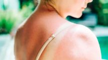 Riskiest skin cancer cases hit record high in UK