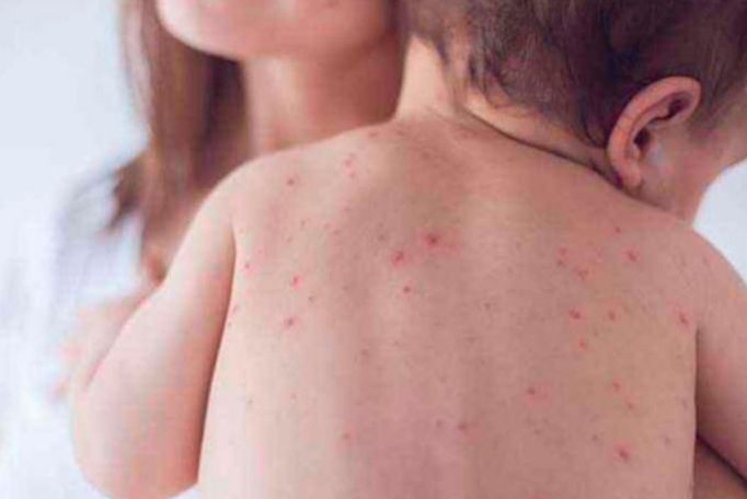 Armenia reports 12 new measles cases in one week