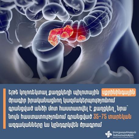 Կոլոռեկտալ քաղցկեղի վաղ հայտնաբերման ծրագրից կօգտվեն նաև քաղցկեղ ունեցողների ազգականները