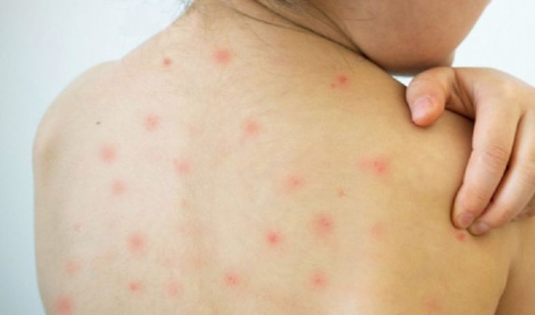 More chickenpox cases reported in Armenia