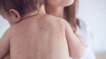 Measles cases across Europe, including Armenia, continue to surge