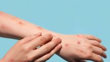 No mpox cases recorded in Armenia