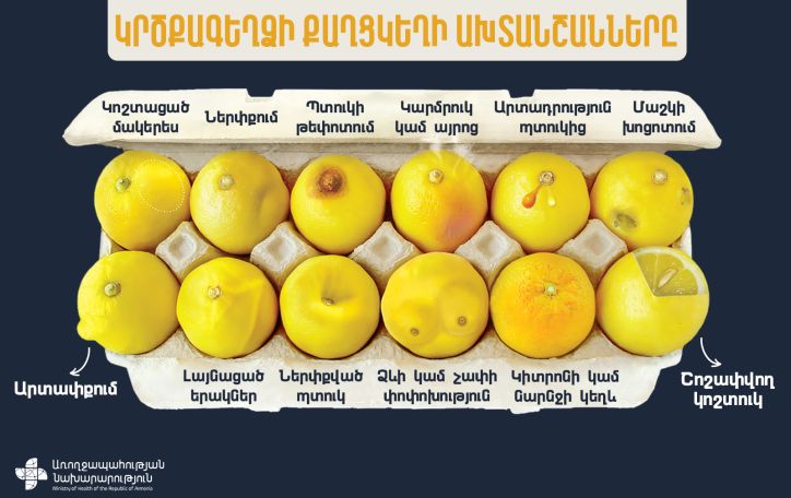 Որոնք են կրծքագեղձի քաղցկեղի ախտանշանները. ներկայացնում է մասնագետը
