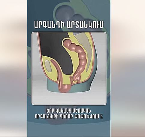 Որոնք են արգանդի արտանկմնա պատճառները.  Մանրամասնում է գինեկոլոգը