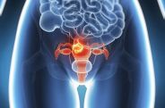 Armenia reports 260 new cases of cervical cancer every year