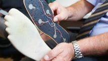 Artificial leg allows patient to feel