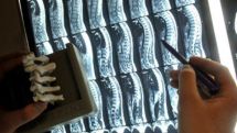 Ученые нашли причину боли в спине человека – анатомическое сходство с обезьянами  