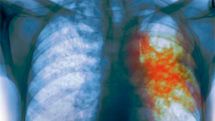 YSU student diagnosed with tuberculosis