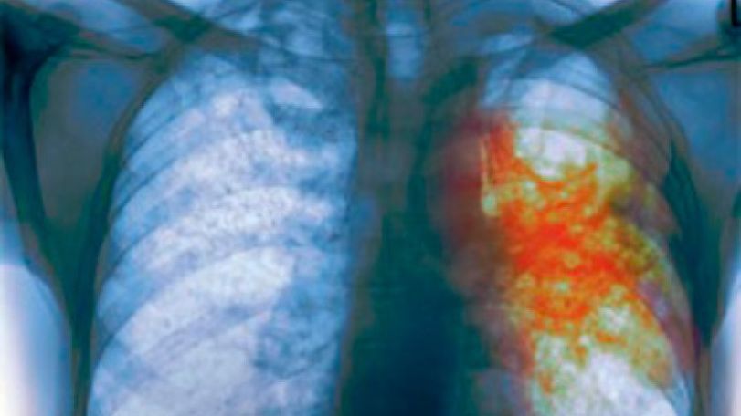 YSU student diagnosed with tuberculosis