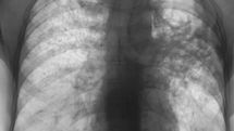 Azadlig: Tuberculosis cases increase 56 percent in Azerbaijan due to hard living conditions 