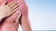 Sunlight continues to damage skin hours after exposure