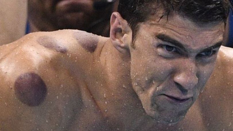 BBC on why so many Olympians are covered in large red circles