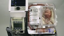 Surgeons transplant heart that had stopped beating