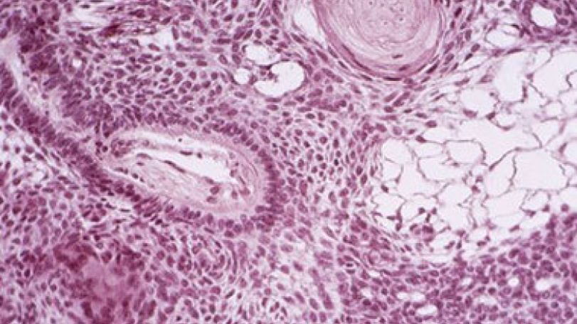 Cancer-killing cells made in the lab