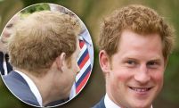 Balding Prince Harry visits hair loss clinic for thickening treatments