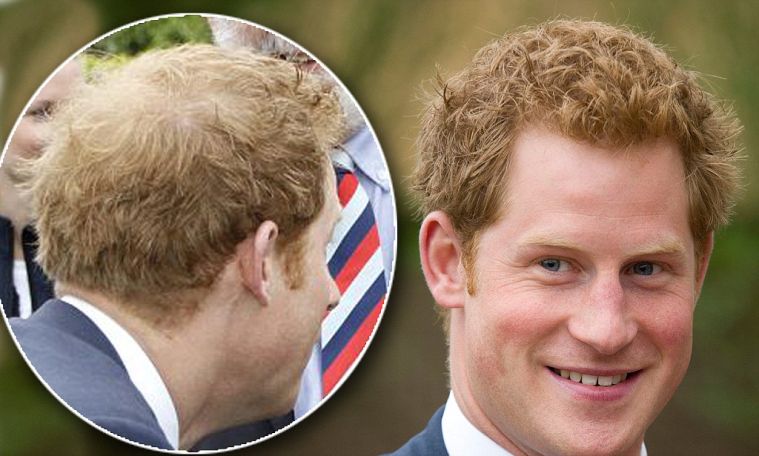 Balding Prince Harry visits hair loss clinic for thickening treatments