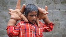 В Индии ладони 8-летнего мальчика из-за редкого заболевания стали весить по 8 килограммов 