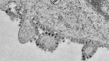 72-year-old coronavirus patient dies in Yerevan hospital