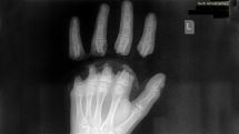 Dog’s steel rope cuts off child's four fingers in Yerevan