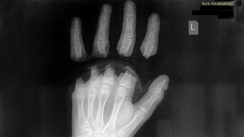 Dog’s steel rope cuts off child's four fingers in Yerevan