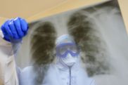 Глава Роспотребнадзора: Коронавирус утратил способность проникать в легочную ткань