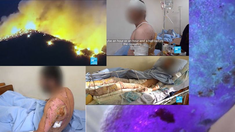 Phosphorus burns in 44-day war: restricted movement, disfigurement