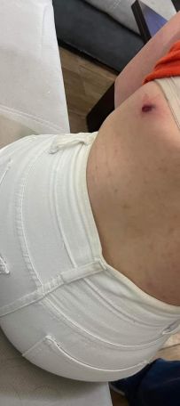 Участница борьбы, пострадавшая вследствие применения светошумовой гранаты