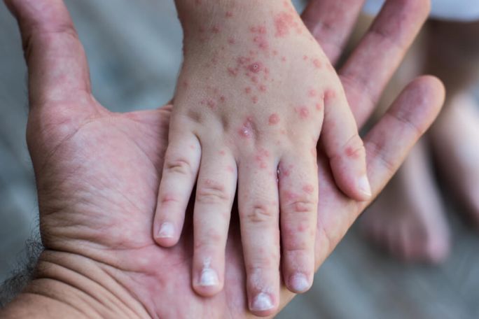 Monkeypox cases rise to more than 3,400 globally, WHO says