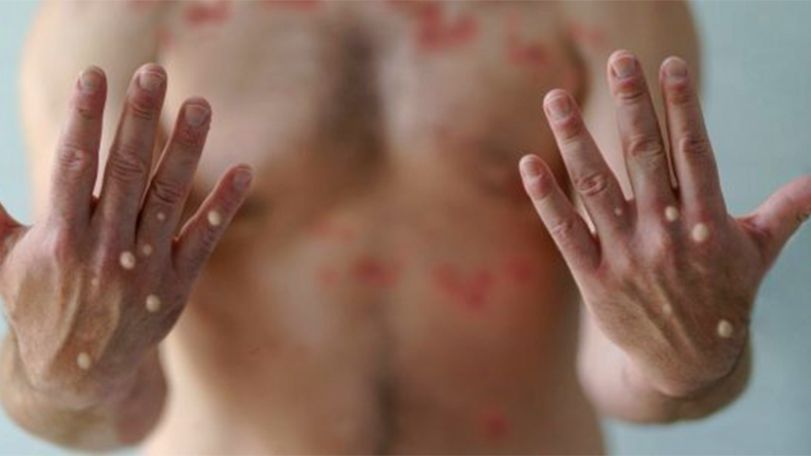 Turkey records first monkeypox case
