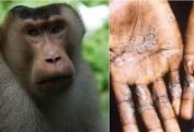 US confirms first two monkeypox cases in children