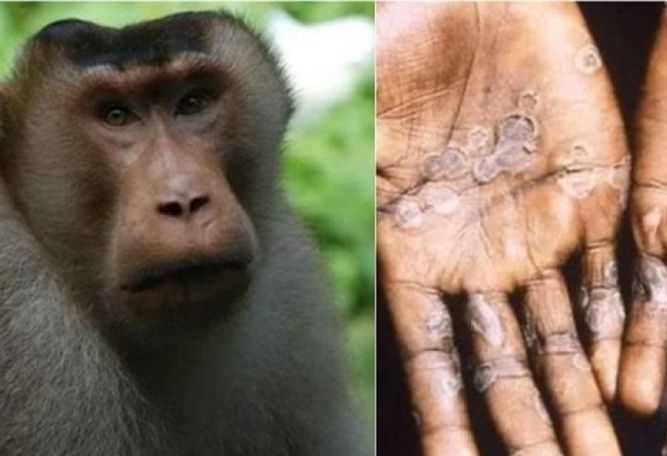 US confirms first two monkeypox cases in children