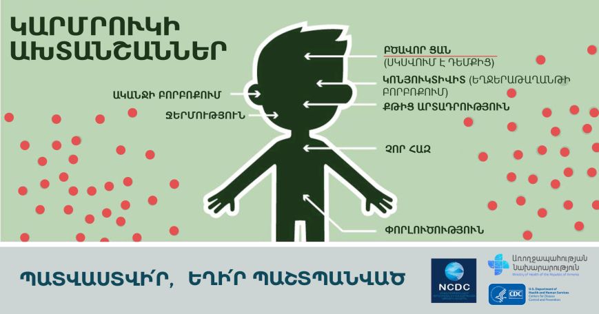 Measles cases rising in Armenia
