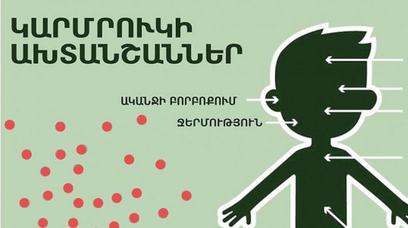 Минздрав Армении: Число лабораторно подтвержденных случаев кори увеличивается