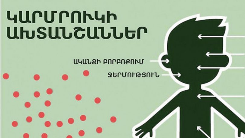 В Армении число лабораторно подтвержденных случаев кори достигло 39