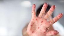 13.03. В Армении число лабораторно подтвержденных случаев кори достигло 50