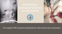 Врачи в Армении извлекли из желудочно-кишечного тракта 3-летнего ребенка 17 магнитов