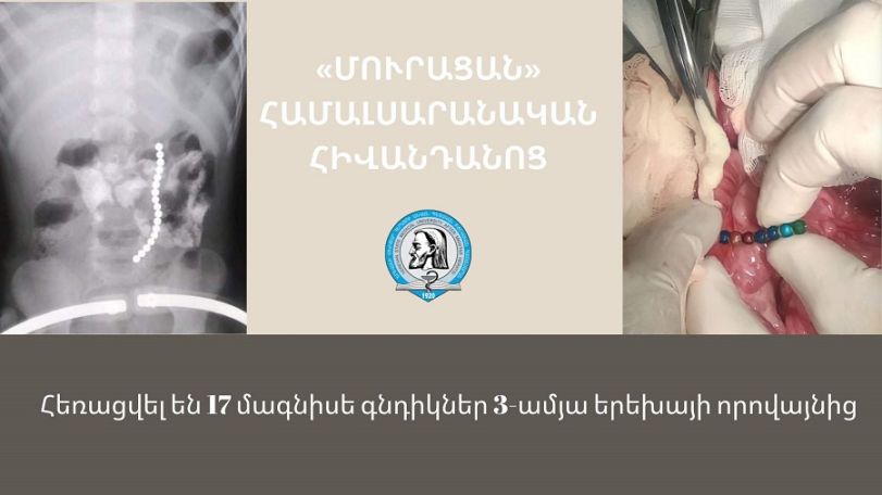 Врачи в Армении извлекли из желудочно-кишечного тракта 3-летнего ребенка 17 магнитов