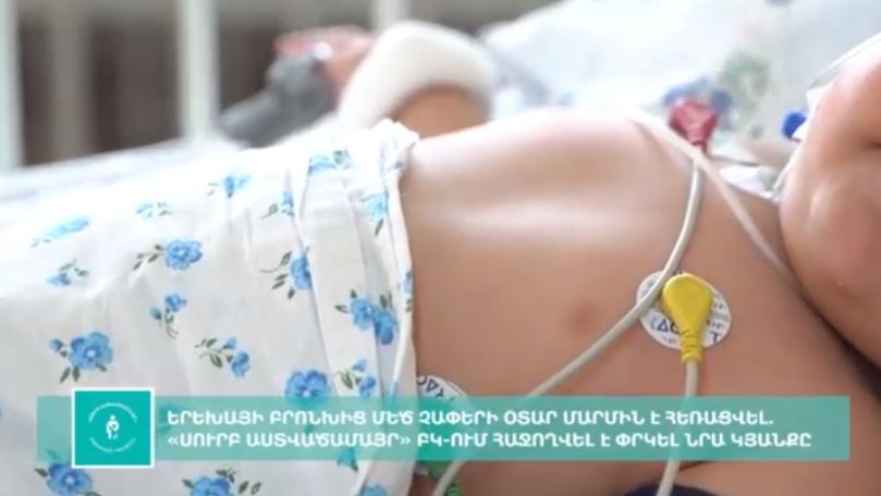 «Սուրբ Աստվածամայր» ԲԿ-ում 10 ամսական երեխայի բրոնխից մեծ չափերի օտար մարմին է հեռացվել