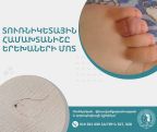 Տուռնիկետային համախտանիշը երեխաների մոտ. վտանգներից մինչև բուժում