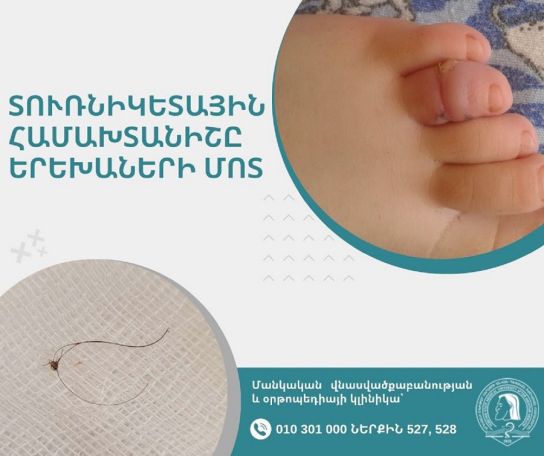 Տուռնիկետային համախտանիշը երեխաների մոտ. վտանգներից մինչև բուժում
