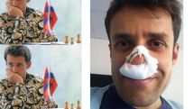 Aronian has nose surgery