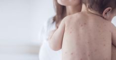 More measles cases reported in Armenia