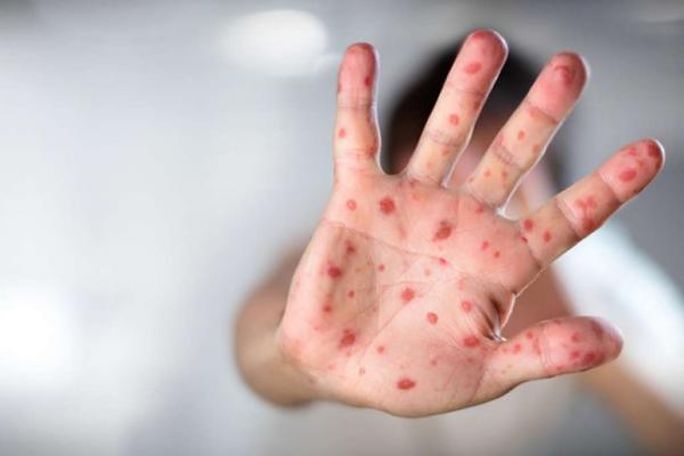 More measles cases reported in Armenia