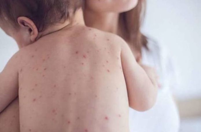 Child dies of measles in Armenia