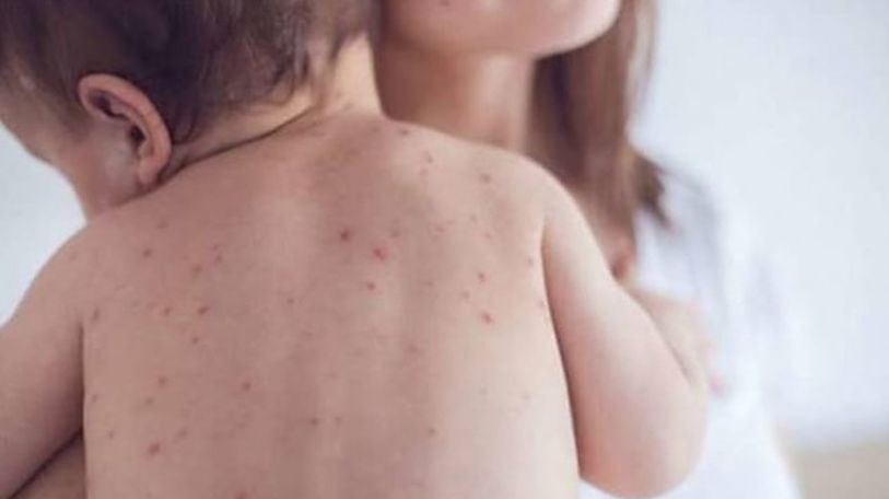 More measles cases confirmed in Armenia