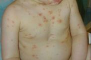 Armenia to introduce chickenpox vaccination program next year