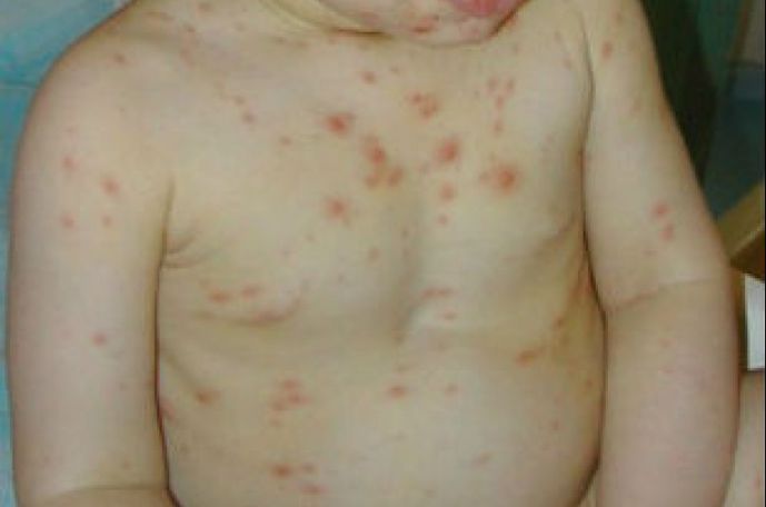 Armenia to introduce chickenpox vaccination program next year